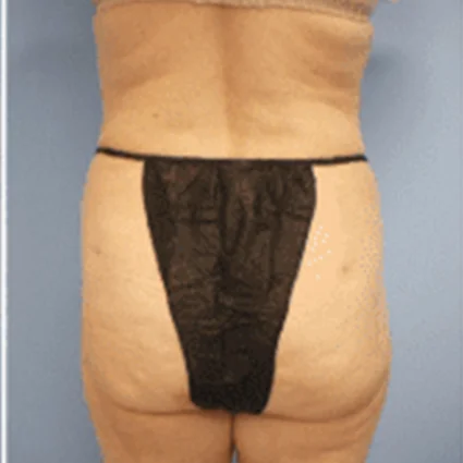 Liposuction Patient after