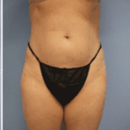 Liposuction Patient after