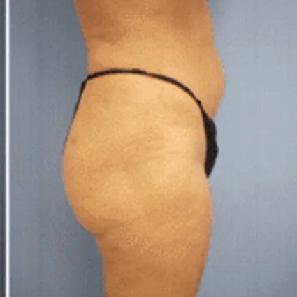 Liposuction Patient after