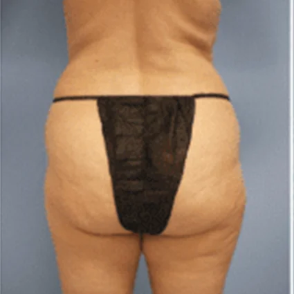 Liposuction Patient before