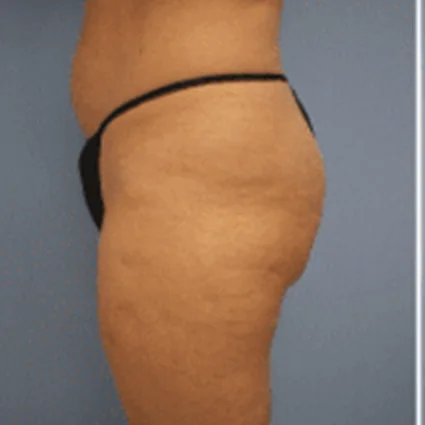 Liposuction Patient before