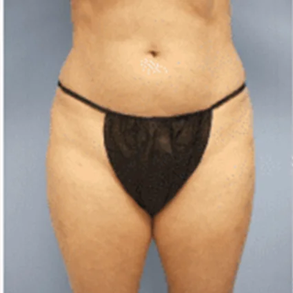 Liposuction Patient before