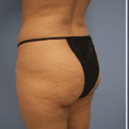 Liposuction Patient before