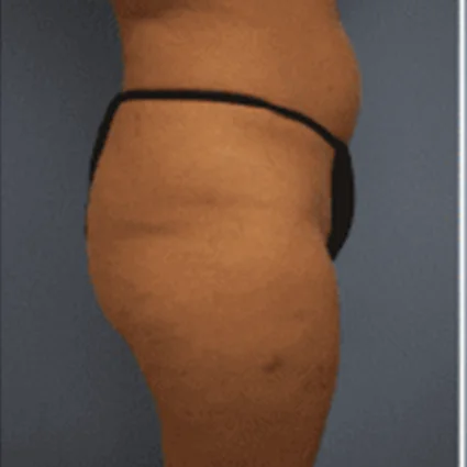 Liposuction Patient before