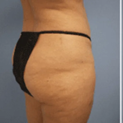 Liposuction Patient before