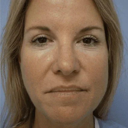 Nose Reshaping Patient After