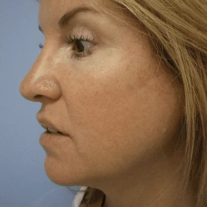 Nose Reshaping Patient After