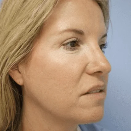 Nose Reshaping Patient After
