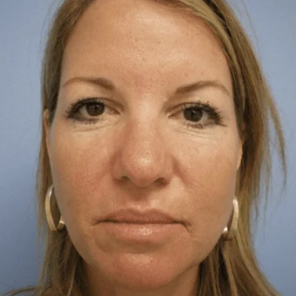 Nose Reshaping Patient Before