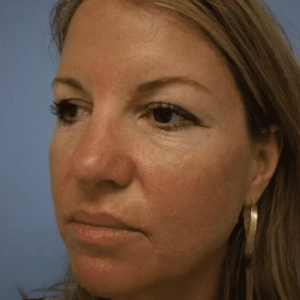 Nose Reshaping Patient Before