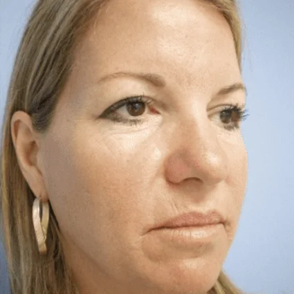 Nose Reshaping Patient Before