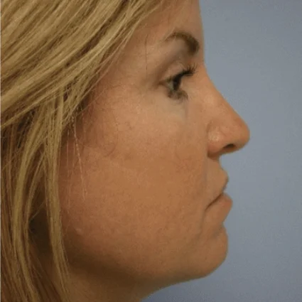 Nose Reshaping Patient Before