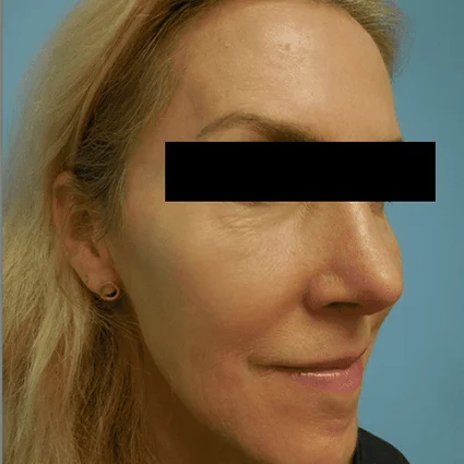 Nose Reshaping Patient After