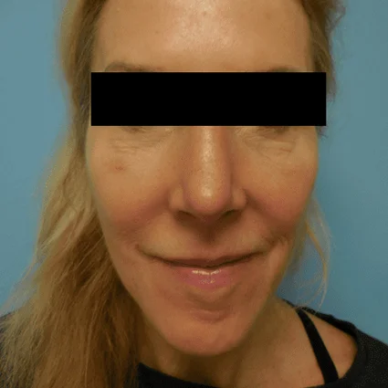 Nose Reshaping Patient After