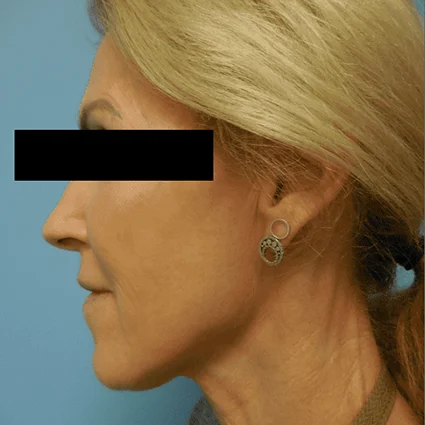 Nose Reshaping Patient Before