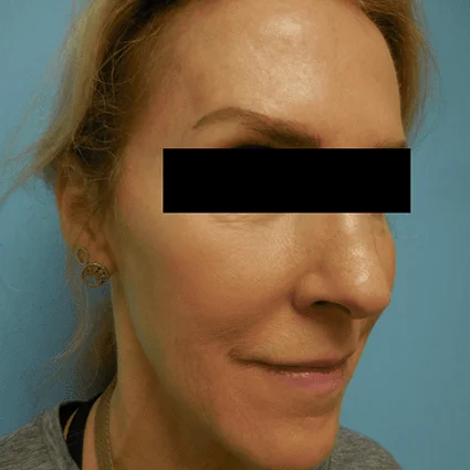 Nose Reshaping Patient Before
