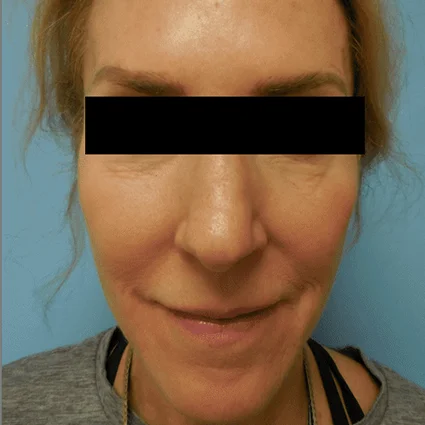 Nose Reshaping Patient Before