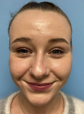 Nose Reshaping Patient 3 Before