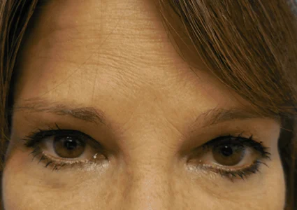 Eye Lid Lift Patient before