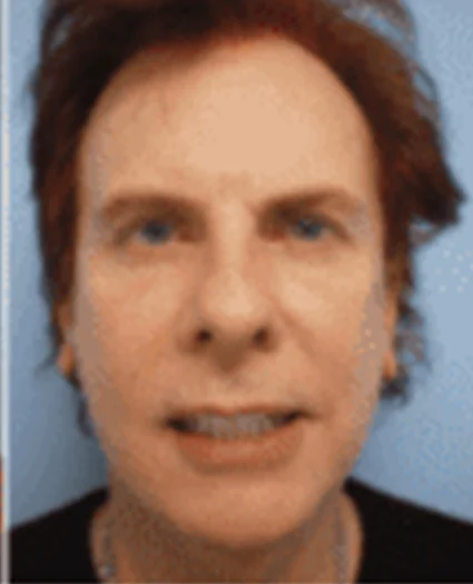 Face Lift Patient After