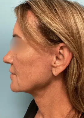 Face-Lift-Patient-4-after-3