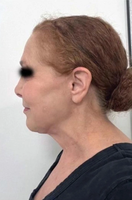 Face Lift Patient 5 After 2