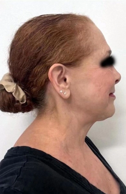 Face Lift Patient 5 After 3