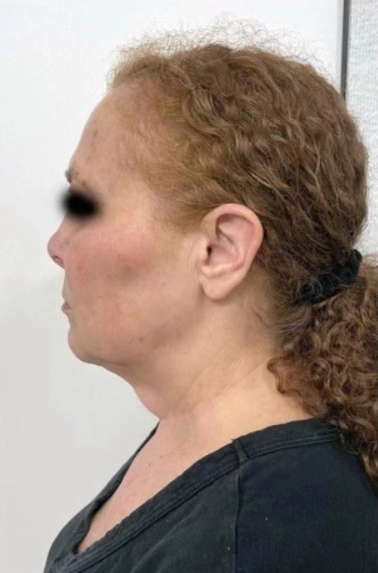 Face Lift Patient 5 Before 2