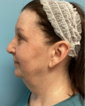 Face Lift Patient 6 Before 2