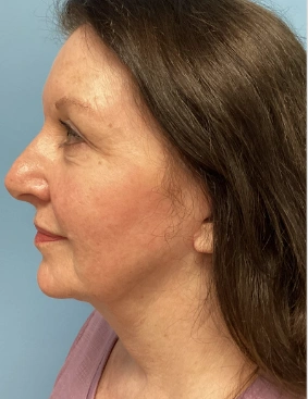 Face Lift Patient After 2