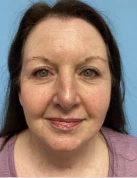 Face Lift Patient After